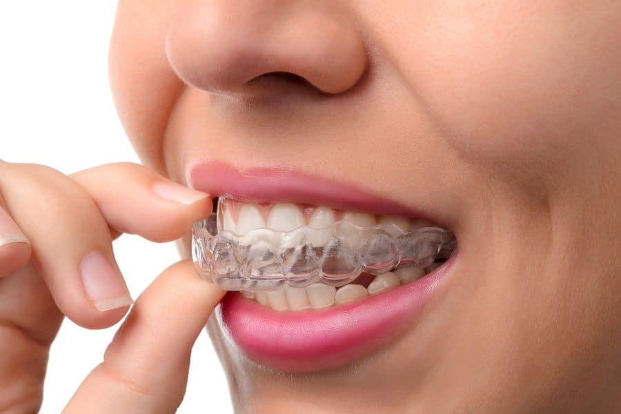 Invisalign® in Homewood, IL – How it Differs from Metal Braces