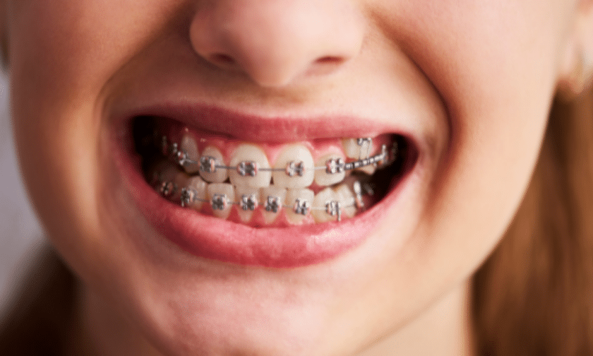 Why Are Traditional Metal Braces a Great Choice?