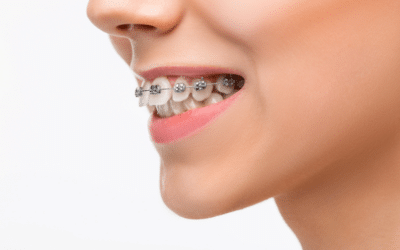 Why Do People Get Braces? Orthodontic Treatment for Straight Teeth and More