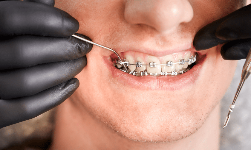 Braces for adult