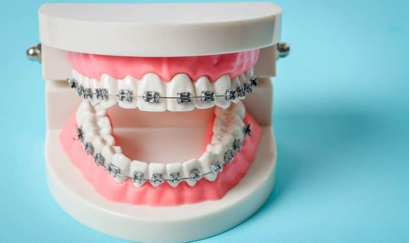 Know The 5 Major Benefits Of Orthodontics