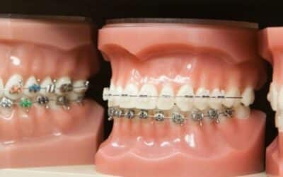 Different Components of Braces Working Together for a Perfect Smile!
