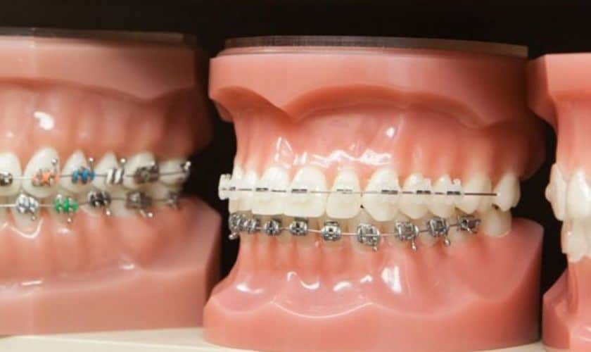 Different Components of Braces Working Together for a Perfect Smile!