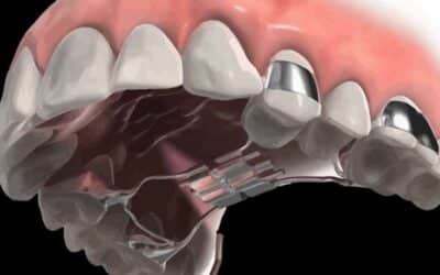 Explaining The Palate Expander & Brace Combo After Retainer Removal