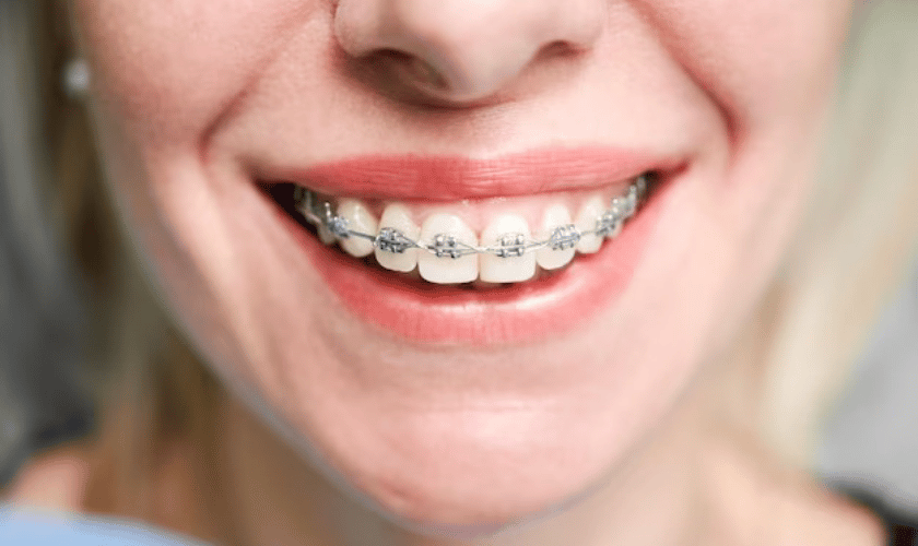 Metal Braces Grant Orthodontics