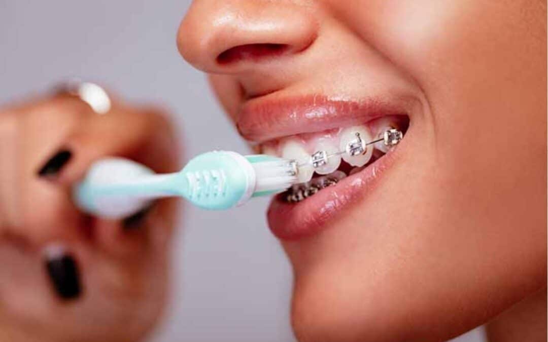 How to Keep Your Braces Clean and Hygienic?