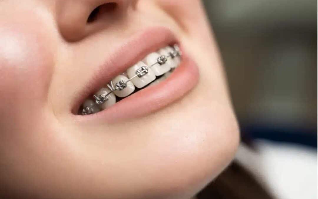 Braces