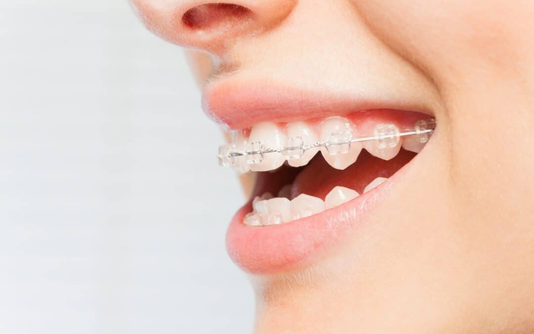 Top Benefits of Choosing Ceramic Braces