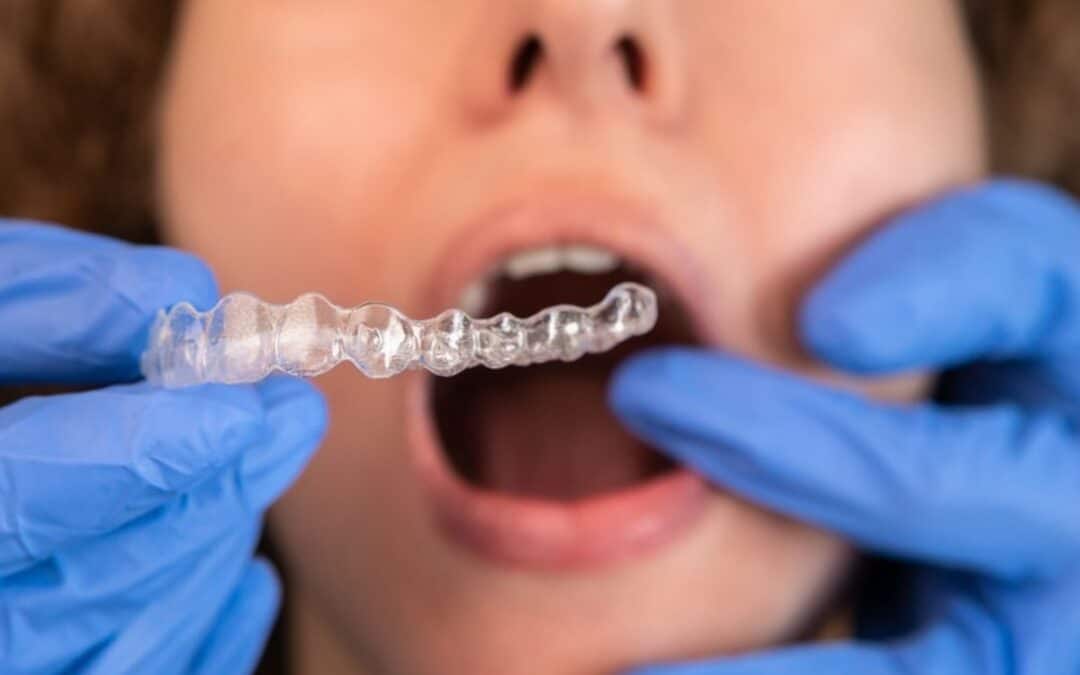 How to Keep Teeth White While Wearing Invisalign