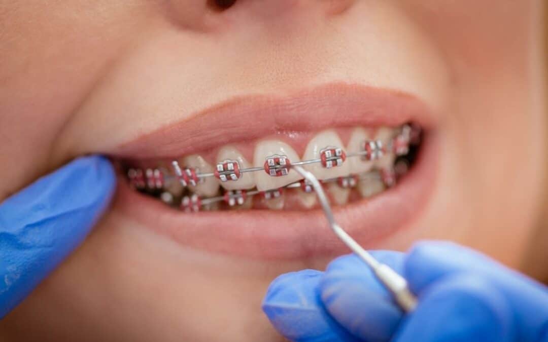 Do metal braces hurt more than other orthodontic options?