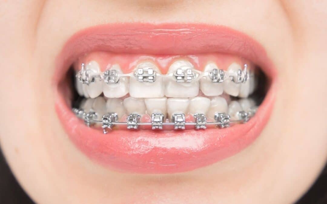 How Do Ceramic Braces Change Daily Oral Hygiene?