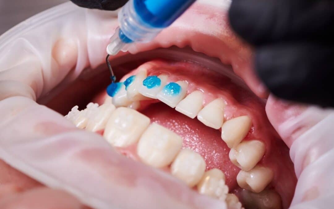 How do you maintain and clean ceramic braces effectively?