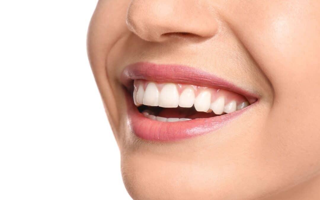 How Can I Maintain My Teeth After Whitening Treatment?