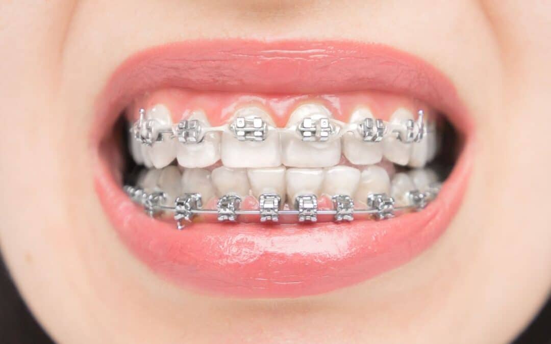 How Long Will I Need Metal Braces for Straight Teeth?